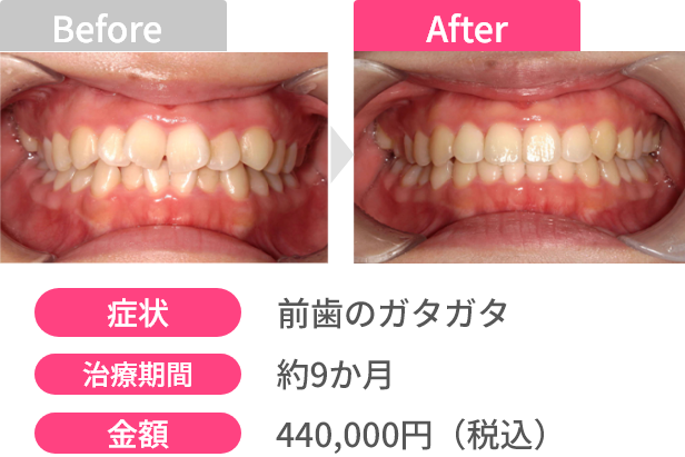 Before After 画像1 - あっという間に変わる！オーダーメイドスピード矯正 | 新美歯科