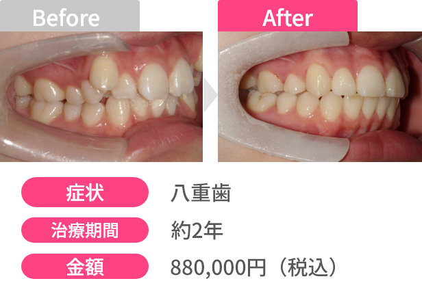 Before After 画像2 - あっという間に変わる！オーダーメイドスピード矯正 | 新美歯科