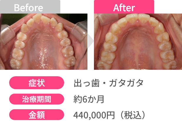 Before After 画像3 - あっという間に変わる！オーダーメイドスピード矯正 | 新美歯科